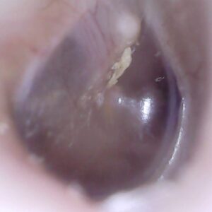 Video Otoscopy of an eardrum after ear wax removal in Hobart