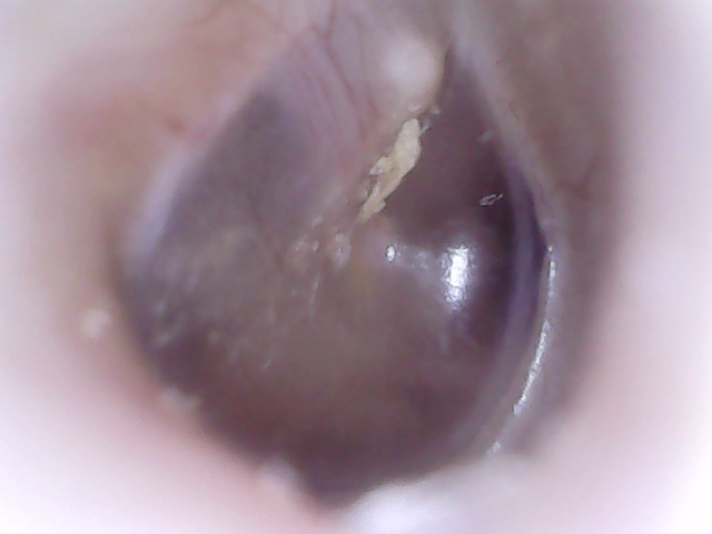 Video Otoscopy Eardrum Earwax removal